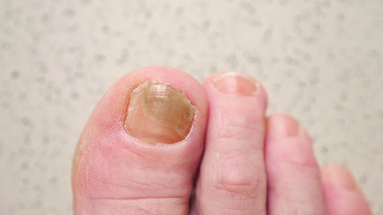 Fingernail Fungus from Fake Nails: Exploring the Causes and Treatment ...